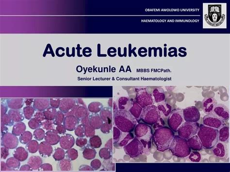 Ppt Acute Leukemias Powerpoint Presentation Free Download Id3841754
