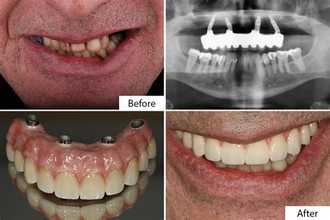 Before And After All On Dental Implants Pictures Dental Partners Of