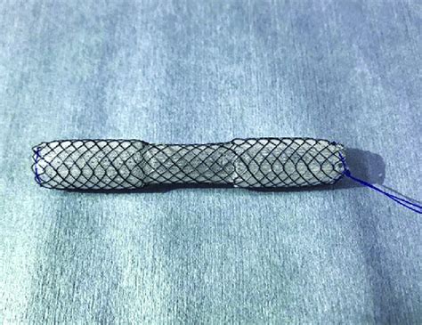 The Fully Covered Self Expanding Metallic Stent Designed To Minimize