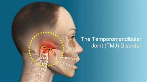 Temporomandibular Joint Syndrome | Musculoskeletal Issues articles