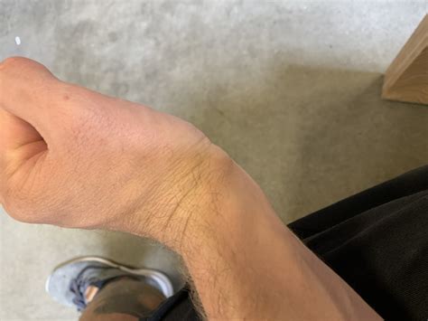 Bump Sticking Out Under Palm Of Hand