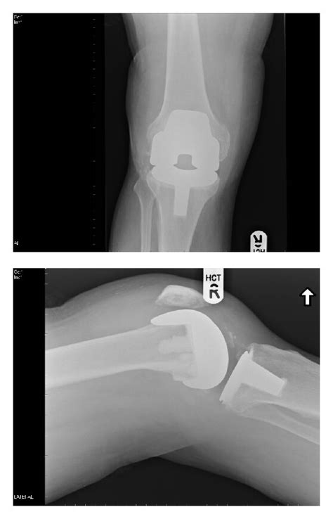 Initial Operative Ap And Lateral Radiographs Of The Right Knee