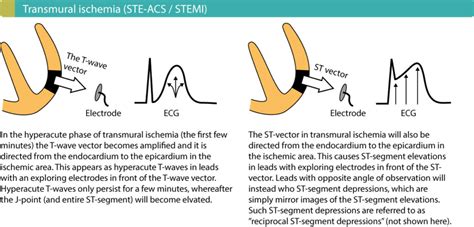 Ecg In Myocardial Ischemia Ischemic Changes In The St Segment And T Wave