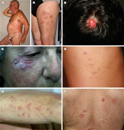 T Cell Lymphoma Staging Peripheral T Cell Lymphoma Diagnosis