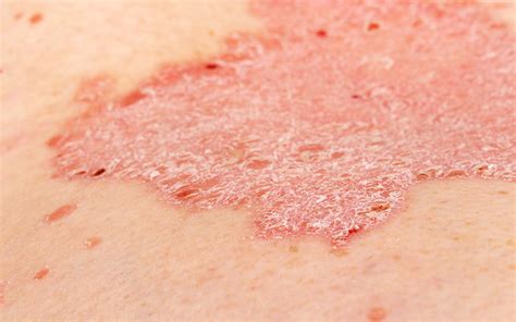 Exfoliative Dermatitis Causes Symptoms Diagnosis And Treatment Vedix