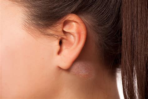 9 Causes Of Lump Behind Ear Symptoms Treatment And Home Remedies