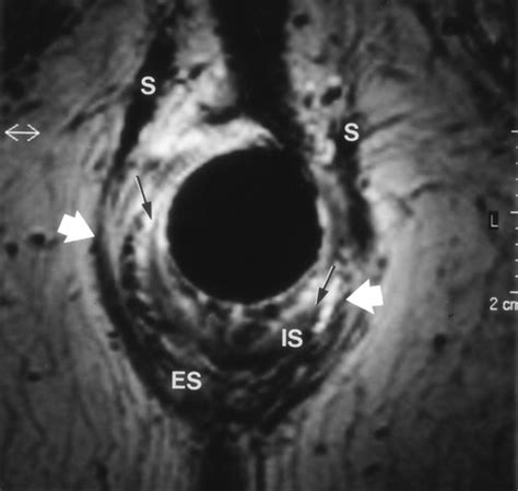 Endoanal Mr Imaging Of The Anal Sphincter In Fecal Incontinence