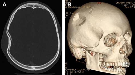 Imaging Of Head Trauma Radiologic Clinics