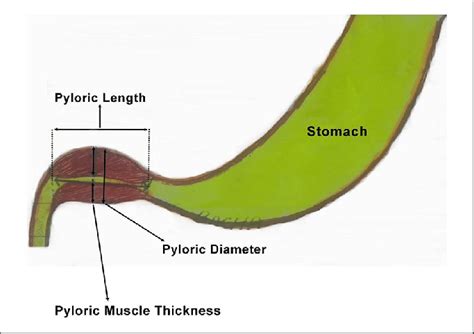 Measurement Method Of Pyloric Length Pyloric Muscle Thickness And