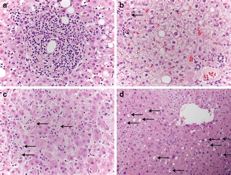 Reactive Hepatitis In A Patient With Celiac Sprue The Biopsy Shows