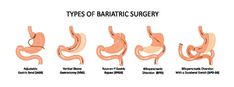 Bariatric Surgery The Johns Hopkins Patient Guide To Diabetes