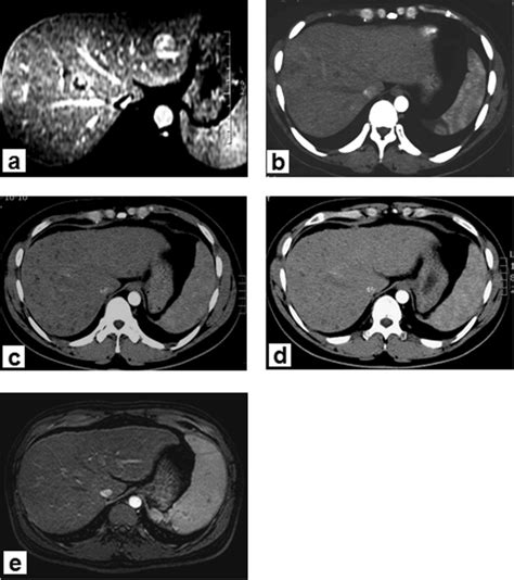 Abdominal Computed Tomography Ct Or Magnetic Resonance Imaging Mri