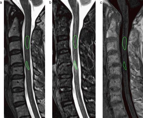 Comparison Of MRI Sequences For Evaluation Of Multiple Sclerosis Of The Cervical Spinal Cord At