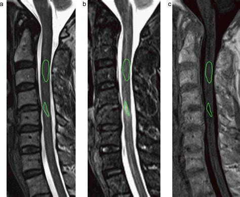 Comparison Of MRI Sequences For Evaluation Of Multiple Sclerosis Of The