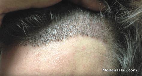Shedding Hair After A Hair Transplant Modena Hair Institute