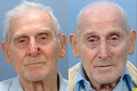 Mohs Surgery Johns Hopkins Facial Plastic And Reconstructive Surgery