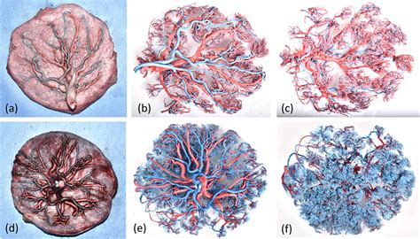 Comparative Study Of Microvascular Structural Changes In The