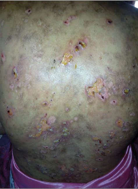 Figure 1 From Severe Bullous Systemic Lupus Erythematosus Successfully