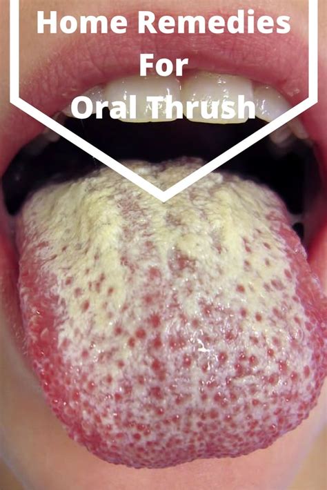 Top 12 Home Remedies For Oral Thrush How To Get Rid Of Oral Thrush