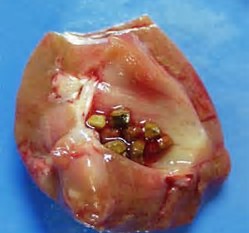 Image result for gout kidney stones