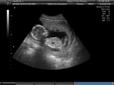 Of course i'll get ultrasounds! 3/D4/D Ultrasound at 14 weeks 6 days Gender Reaveal ...