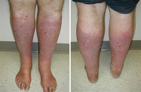 Stasis Dermatitis Causes Symptoms Diagnosis And Treatment