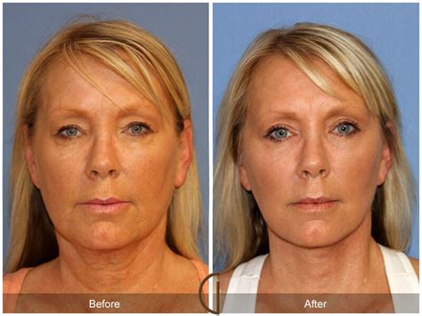 Facelift Fifties Before And After Photos Patient 54 Dr Kevin Sadati