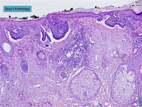 Qiaos Pathology Superficial Multicentric Basal Cell Carcinoma