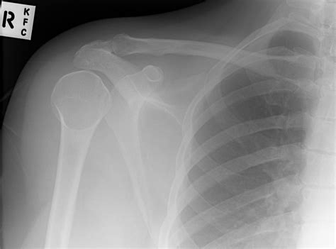 Get information about shoulder dislocation causes, symptoms, signs, diagnosis, treatment (reduction or surgery), complications, recovery time, and rehabilitation. Shoulder pain. Diagnosis? - Emergency Medicine Kenya ...