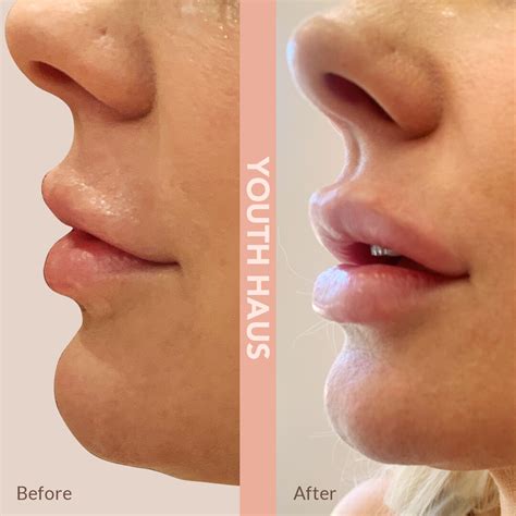 Before After Lip Injections Botox Injectables Youth Haus