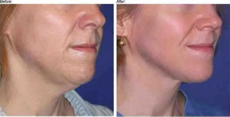 Sagging Neck Skin Exercises Solutions Surgery Home Remedies Turkey