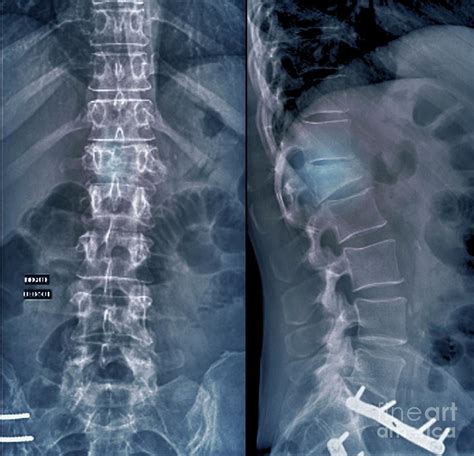 Compression Fracture Of A Lumbar Vertebra Photograph By Zephyr Science