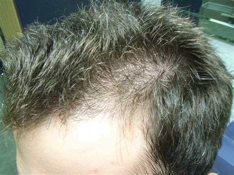 The Hair Loss Centre Male Hair Loss Treated Photos Regrowth On