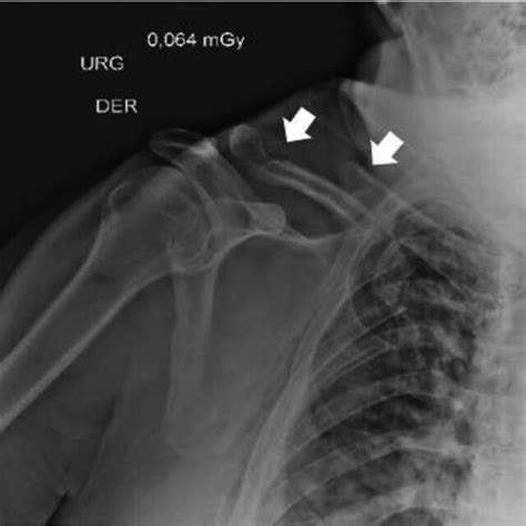 Robinson Type 2b2 Segmental Fracture Of The Right Clavicle Arrows