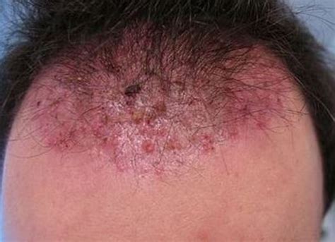 But the problem is more common in people who have very curly or coarse hair. Ingrown Hair on Scalp, Head, Cyst, Pictures, Big, Infected ...
