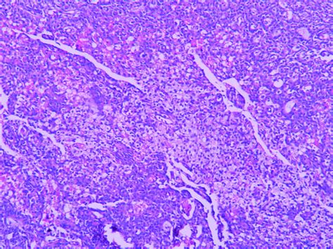 Solid Pseudopapillary Neoplasm Of Pancreas Histopathologyguru