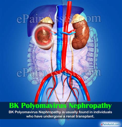 Bk Polyomavirus Nephropathy Causes Symptoms Diagnosis Treatment
