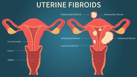 Uterine Fibroids And Your Period Everyday Health