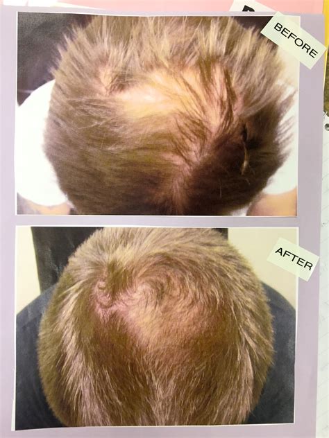 Laser Hair Growth Treatment Call For Free Consultation Las Vegas Reno