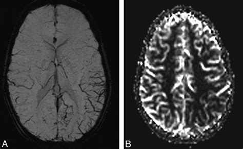 Susceptibility Weighted Imaging In Migraine With Aura American Journal Of Neuroradiology