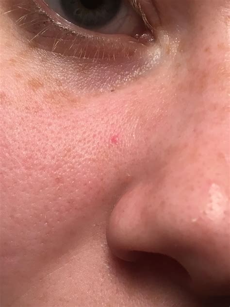 Skin Concerns What Is This Permanent Red Dot On My Face Nose Ring