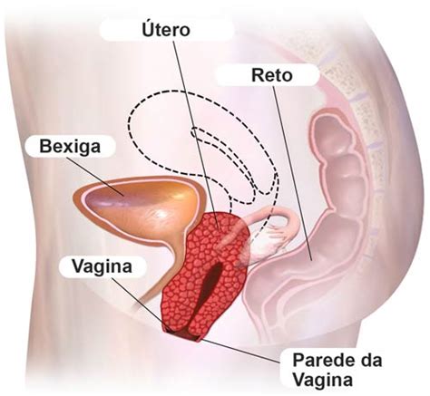 Prolapso Uterino O Que Sintomas Causas E Tratamento Mundoboaforma The