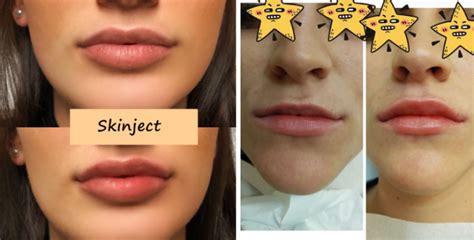 Juvederm Dermal Filler Lip Injection Ultra 4 For Lip Enlargement