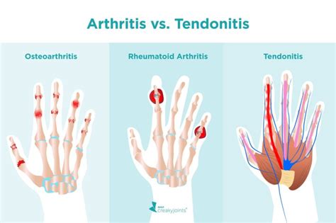 Whats The Difference Between Arthritis And Tendonitis