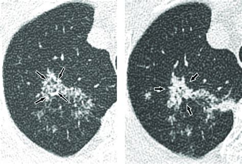 Active Pulmonary Tuberculosis With Predominant Radiologic Findings Of
