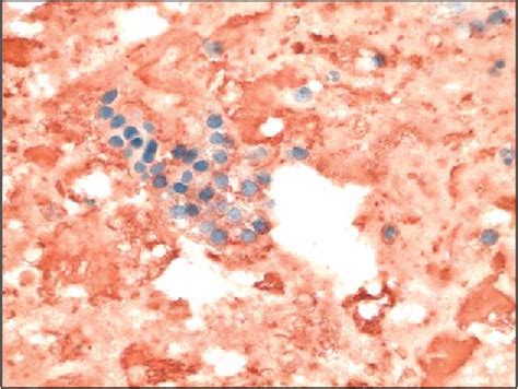 Figure 1 From Aspiration Biopsy Cytology Of Ectopic Thyroid Tissue In