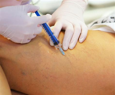 Ultrasound Guided Foam Sclerotherapy La Jolla Vein And Vascular