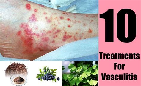 10 Treatments For Vasculitis Asthma Cure Vasculitis Autoimmune