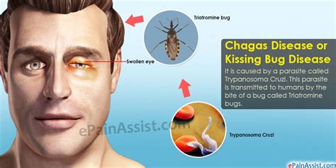 Menumpas Penyakit Chagas Sesawi Net