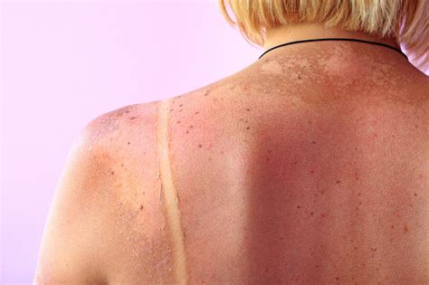 Age Spots Vs Skin Cancer Everything You Need To Know Lifestyle
